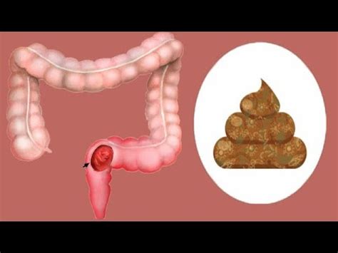 liquid from anus|Rectal Discharge: Causes and Treatments